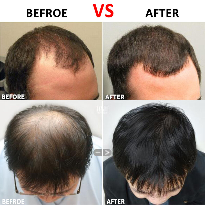 Rodillo Dermaroller de titanio para el crecimiento de la barba, microaguja 540, tratamiento antipérdida de cabello, adelgazamiento