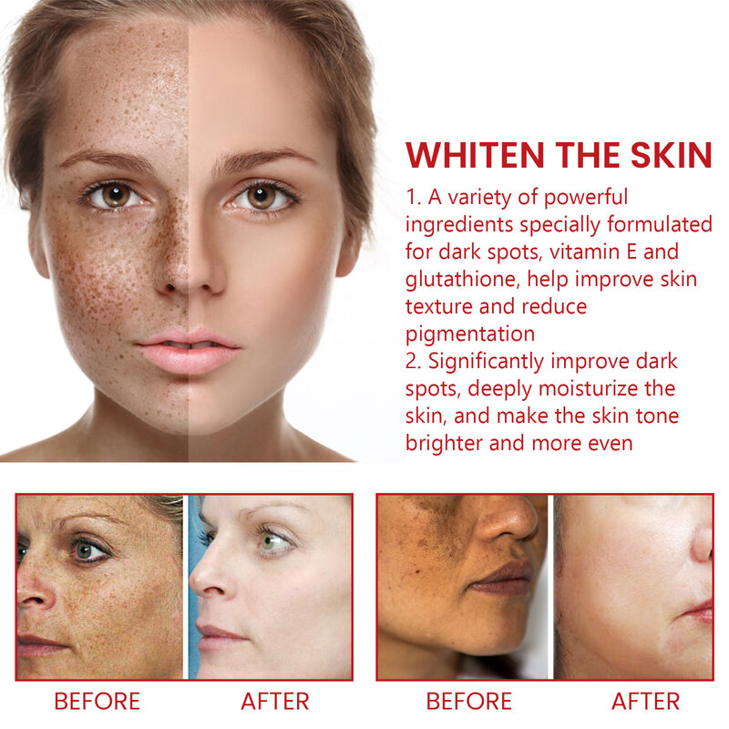 Whitening Freckles Cream Effective Remove Dark Spots Anti Fade Melanin Brighten Nourish Cream Moisturizing Brighten Skin Care