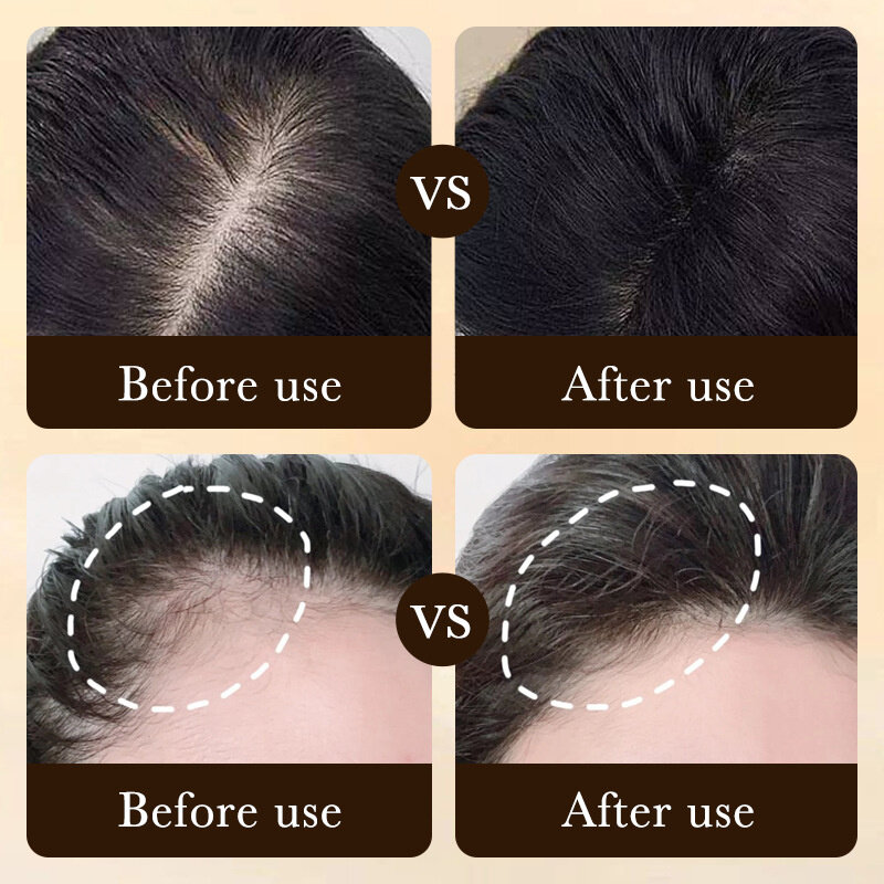 سريع نمو الشعر جوهر فعالة لمكافحة فقدان الشعر المصل الصلع إصلاح وراثي بعد الولادة الدهني فقدان الشعر العناية بالشعر