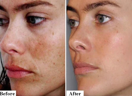 4% tratamento da acne da cara e da pele rugas finas clareamento da pele clareamento da pele melasma x 3 pacote