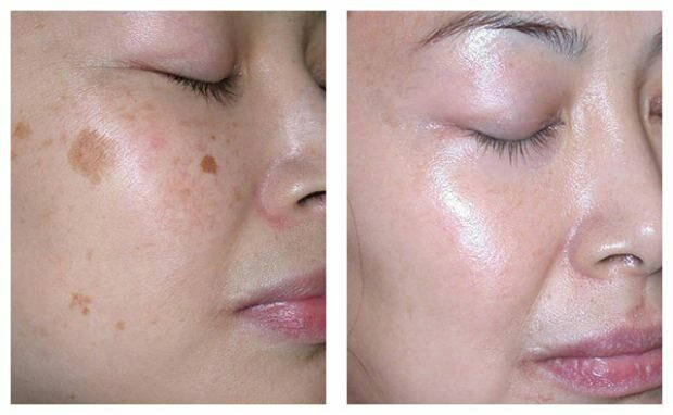 Expimento 4% creme cravo removedor creme clareamento da pele acne cicatriz face care hydroquinone produto original