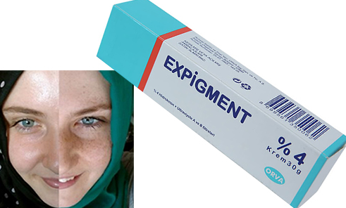 Expig.ment % 4 Cream 30 Gr trattamento per l'acne viso e pelle rughe fini sbiancamento della pelle schiarente per la pelle melasma