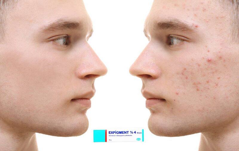Exfoliation % 4 pour le visage et la peau, traitement contre l'acné, les rides fines, blanchiment de la peau, éclaircissement du melazm